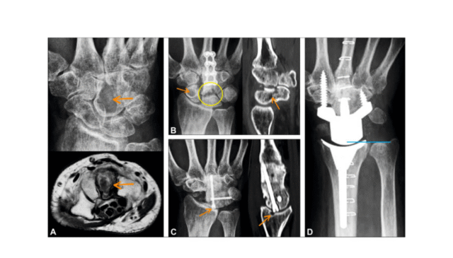 The-Crucial-Role-of-Locking-Screws-in-Total-Wrist-Arthroplasty-Should-We-Always-Revise-or-Not-Figure.png