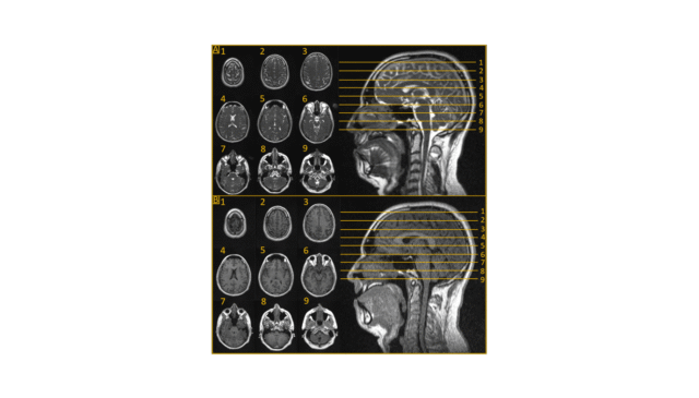 MRI-GUD輻射處理:革命性的中樞神經系統治療 MRI-GUD輻射處理:革命性的中樞神經系統治療