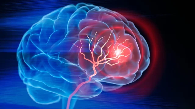 brain-stroke-x-ray.webp.webp