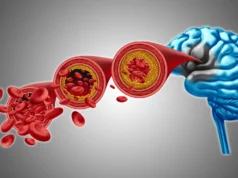 科學家們發現了一種恢復癡呆症患者腦血流量的方法。