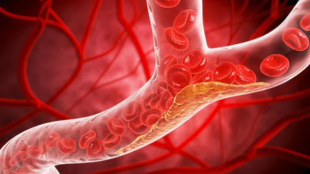 cholesterol-plaque-buildup-narrowed-blood-vessel.webp.webp