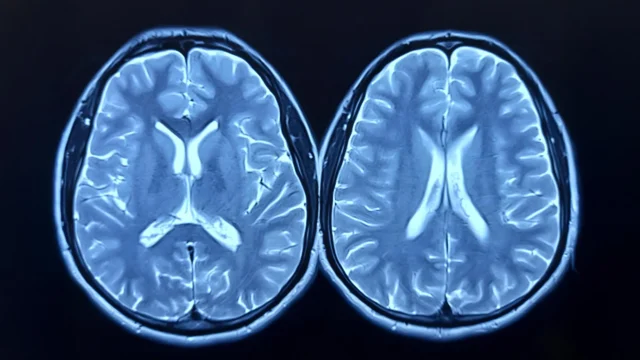 comparison-mri-brain-scans.webp.webp