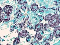 田納西州一種罕見且致命的真菌正在導致人們生病